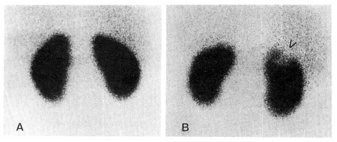 Tc-99m AcidDMSA Renal Scintigraphy in Patients with Pyelonephritis