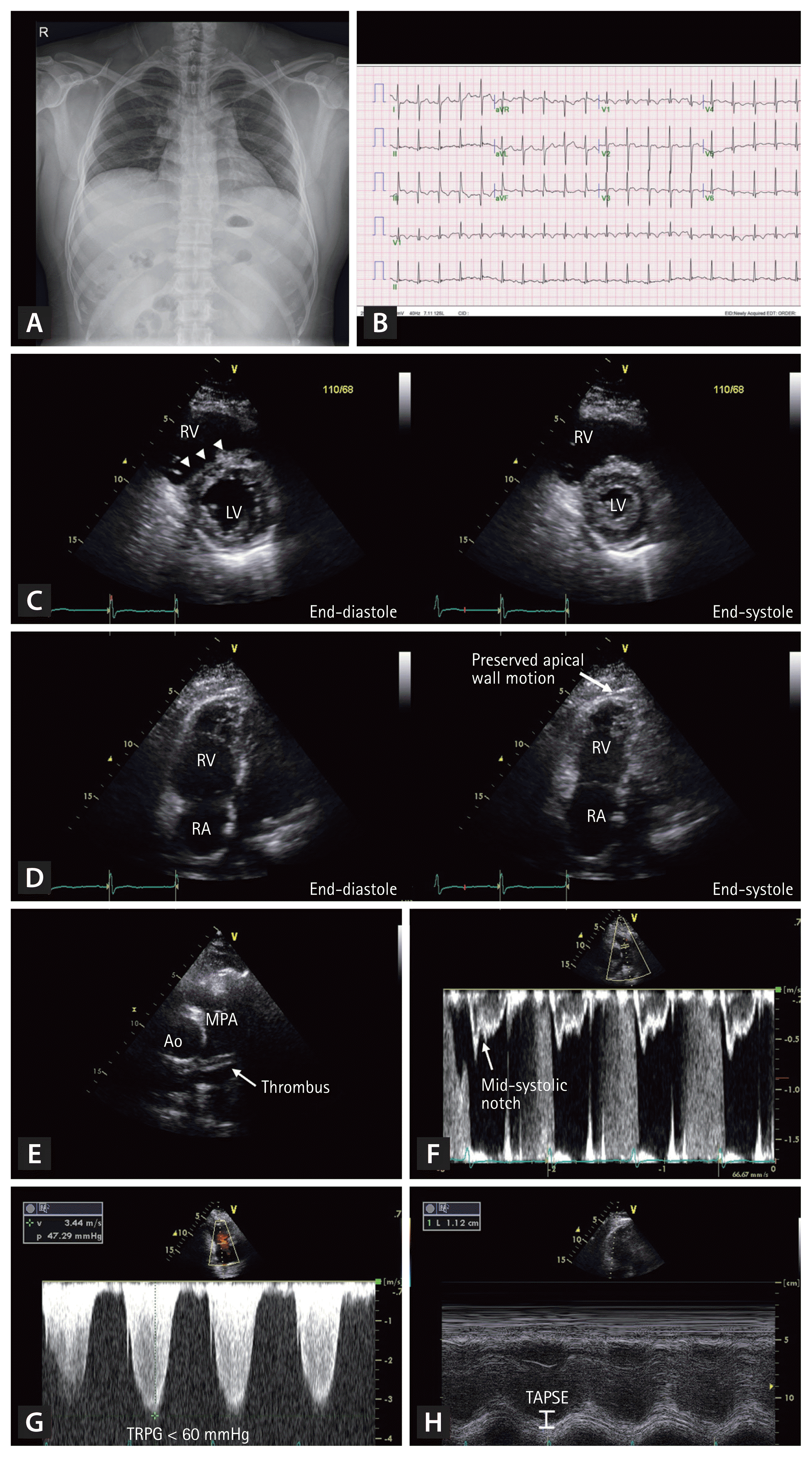 Strain Echocardiography in Acute Cardiovascular Diseases - The Western  Journal of Emergency Medicine