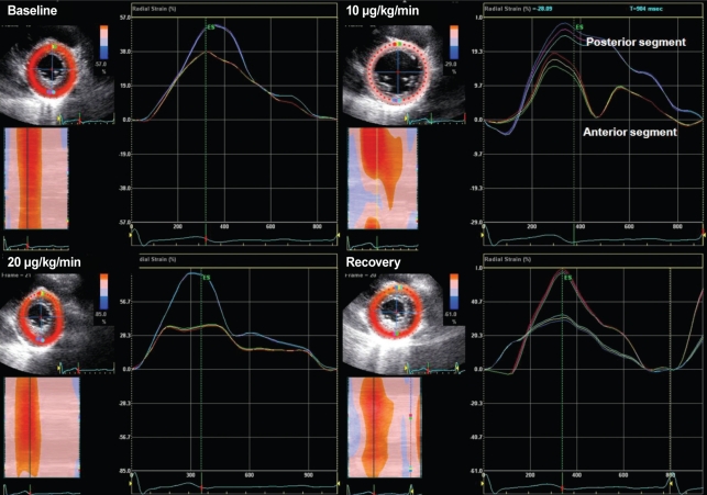 Transthoracic Speckle Tracking Echocardiography for the Quantitative  Assessment of Left Ventricular Myocardial Deformation